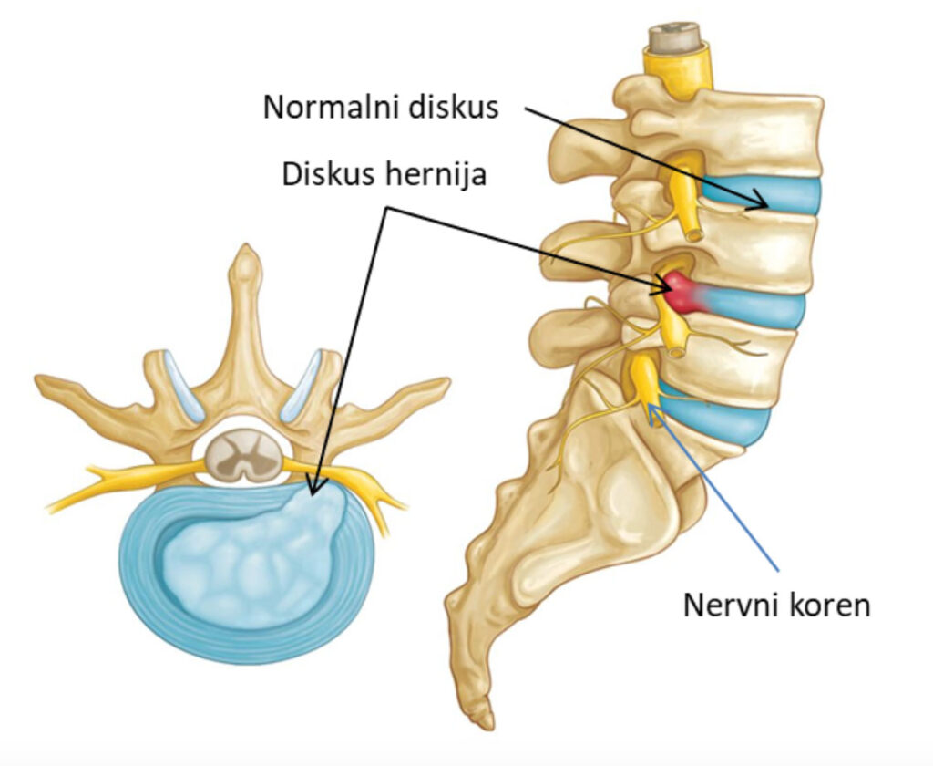 Medicinska ilustracija kičmenog stuba sa prikazom intervertebralnih diskova. Na slici su označeni normalan disk ("Normalni diskus"), diskus hernija ("Diskus hernija") – prikazana kao crveno ispupčenje koje pritiska nerv, i nervni koren ("Nervni koren"). Levo je poprečni presek kičme, gde se vidi kako izbočenje diska može uticati na nerve.